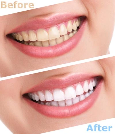 before and after teeth whitening in Crown Point, IN